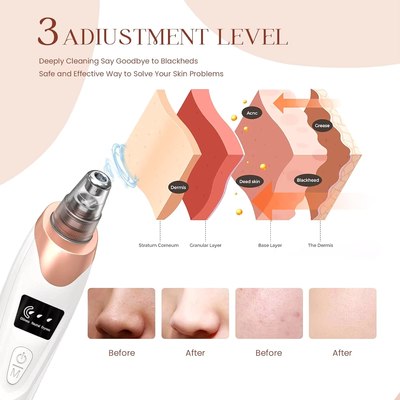 Electric Blackhead Remover Vacuum Cleaner – Pore Cleaner for Face & Nose, Rechargeable Acne Extractor with 3 Suction Levels & 5 Probes